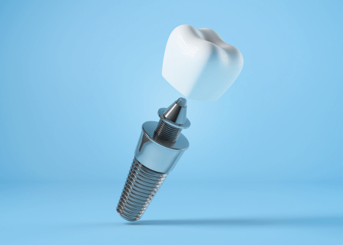 a single dental implant