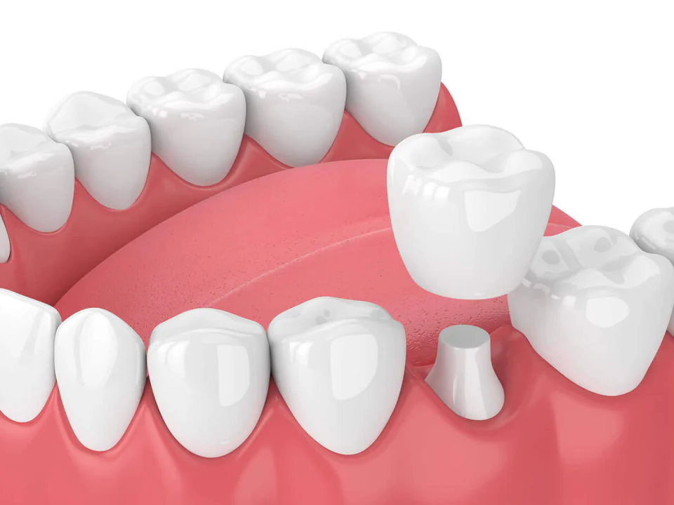 Dental crown and bridge services available at ESI Dentistry North Tampa in Tampa, FL