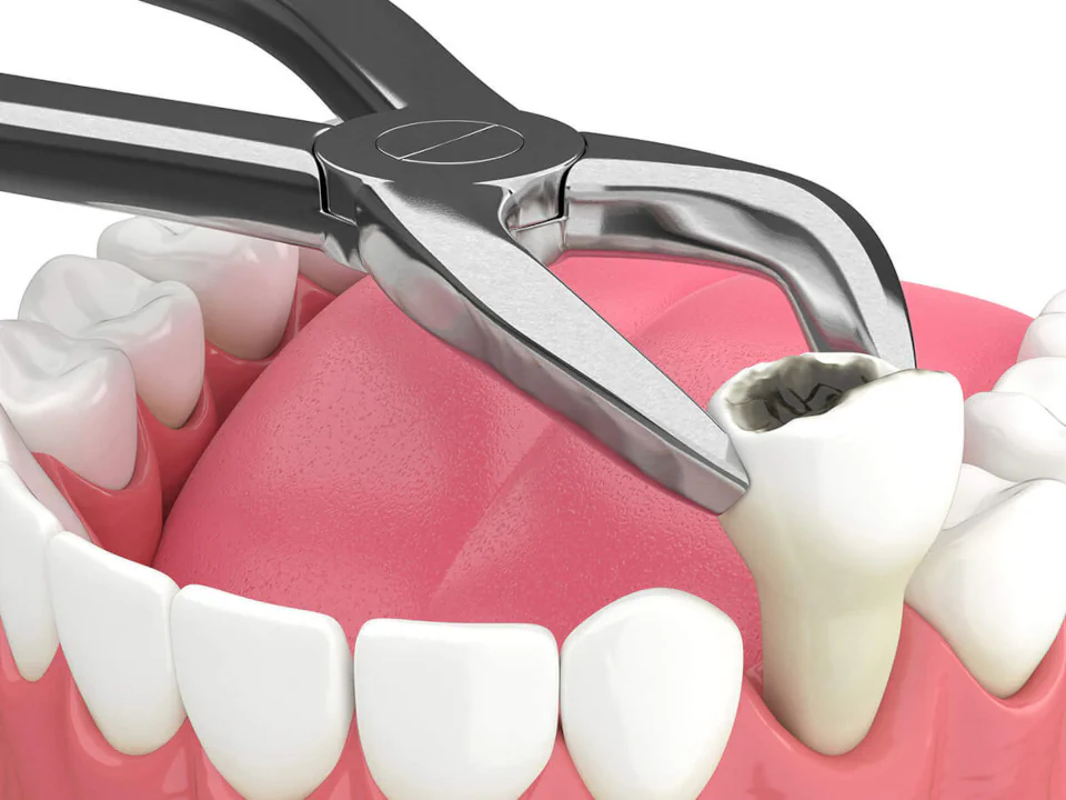Tooth extraction services available at ESI Dentistry North Tampa in Tampa, FL